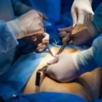 Is Surgery Necessary For Bph Treatments