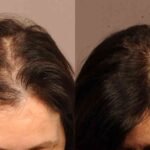 Hair Transplant Turkey
